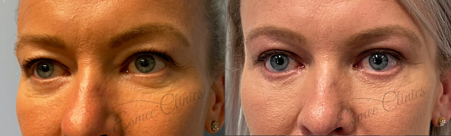 Before and After img